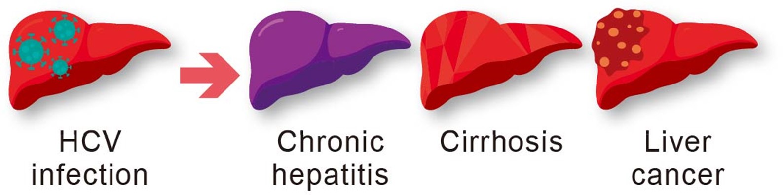 Hepatitis C Virus/HIV Coinfection